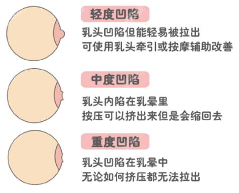 女生乳頭長毛|乳頭內凹、長毛正常嗎？ 8類「乳頭形狀」你的是哪種